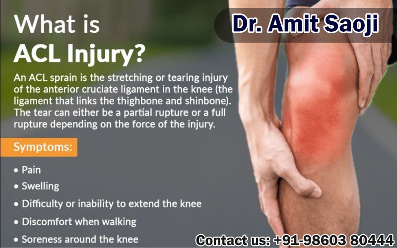 What is an ACL Injury And its Managements ?