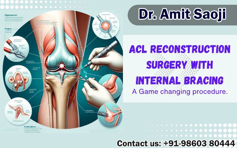 ACL surgery with internal bracing – A game changing procedure